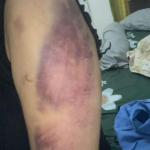 Aniayah Kekasihnya Secara Brutal Oknum Anggota Polres Konawe Utara Di Laporkan Ke Propam Polda Sultra